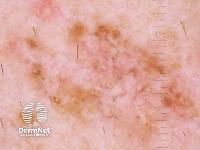 Melanoma in situ 3 dermoscopy
