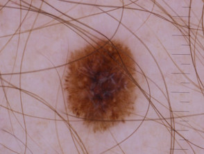 Perpendicular white lines are visible under polarised light dermoscopy of a melanoma in situ 