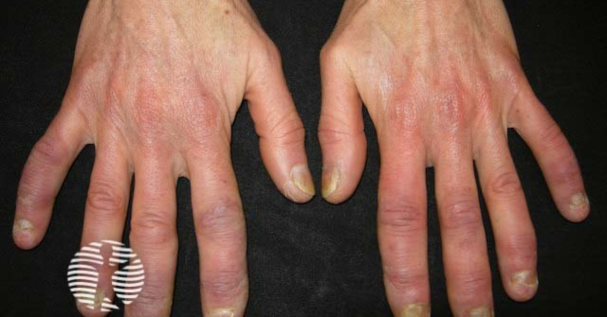 Mixed connective tissue disease image