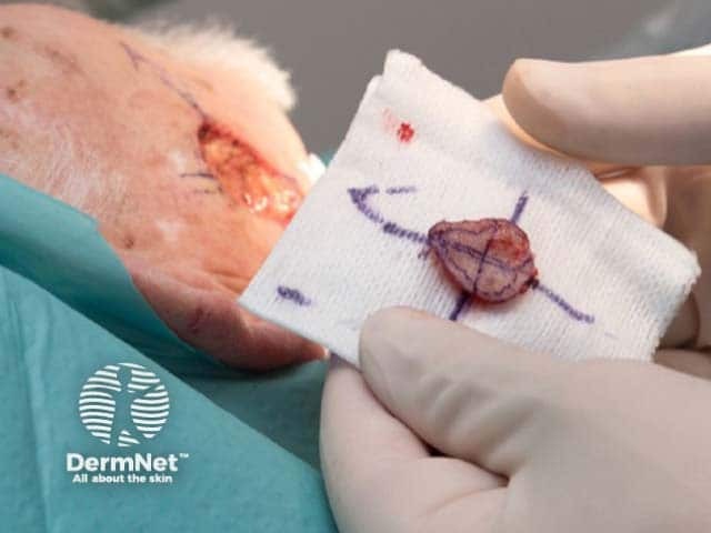 Excision of visible tumour while maintaining orientation