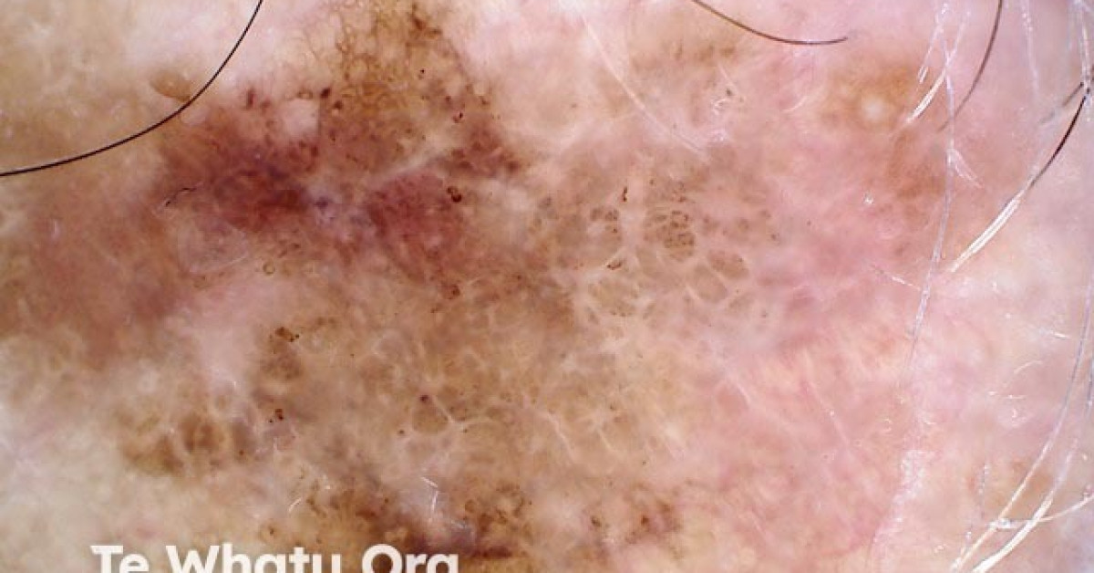 Invasive melanoma image
