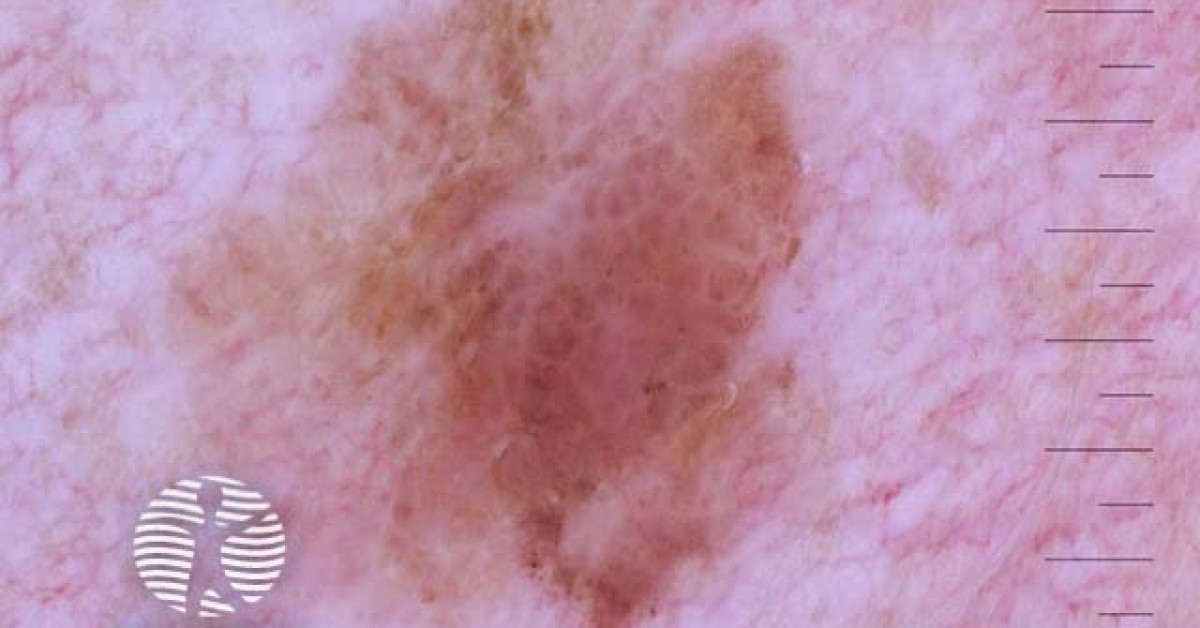 Invasive melanoma image