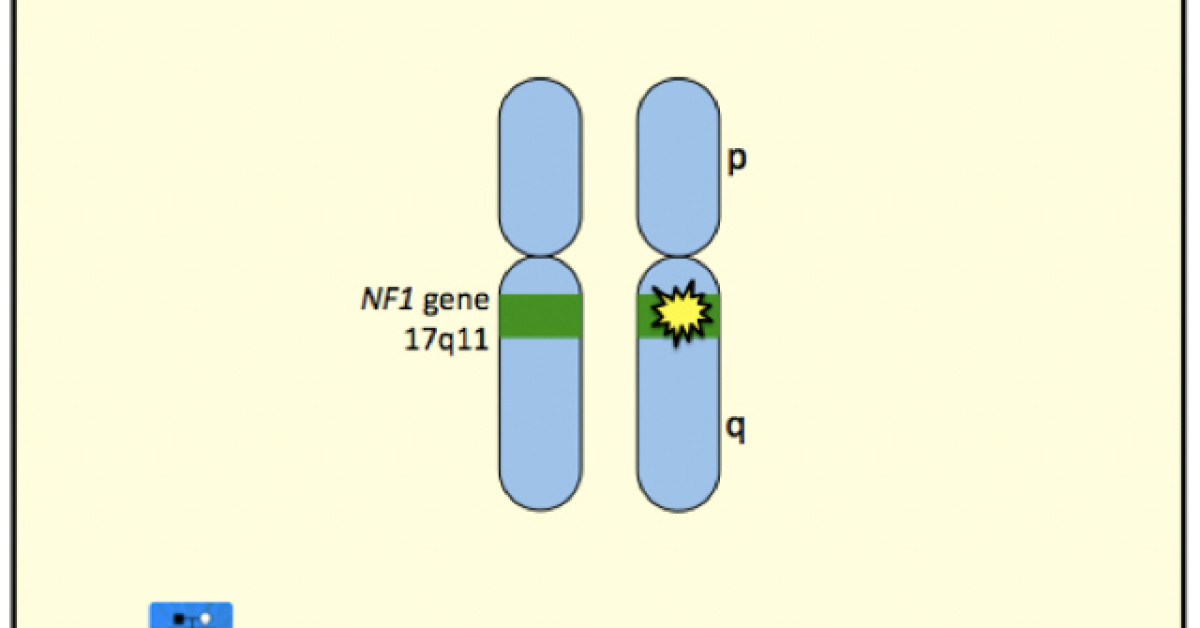 Neurofibromatosis Type 1 image