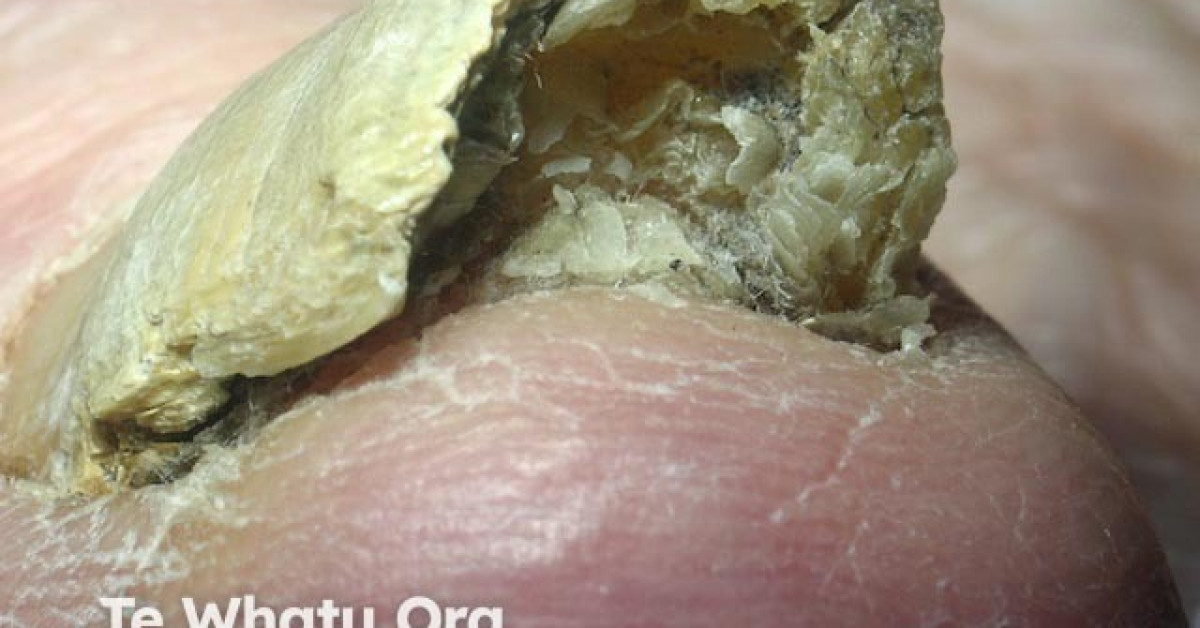 Onychomycosis, toenail image