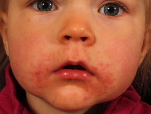 Periorificial dermatitis in a child