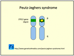 Peutz Jeghers syndrome