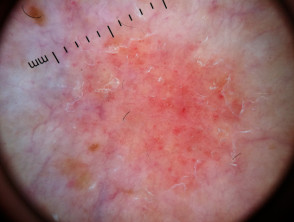Dermoscopic view of psoriasis