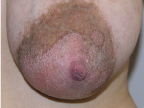 Psoriasis of lactating nipple