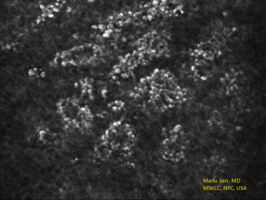 Reflectance confocal microscopy of benign keratosis suprabasal cobblestone pattern