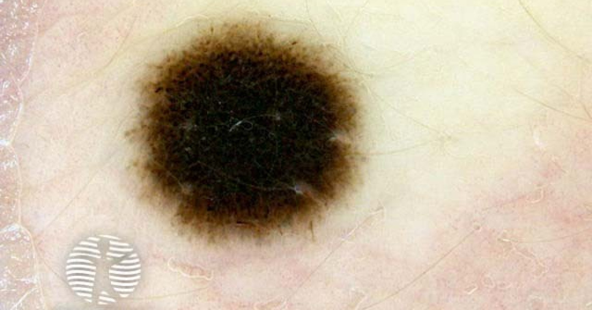 Reed naevus 4 dermoscopy image