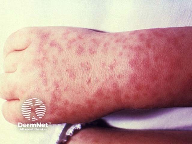 Rocky Mountain spotted fever