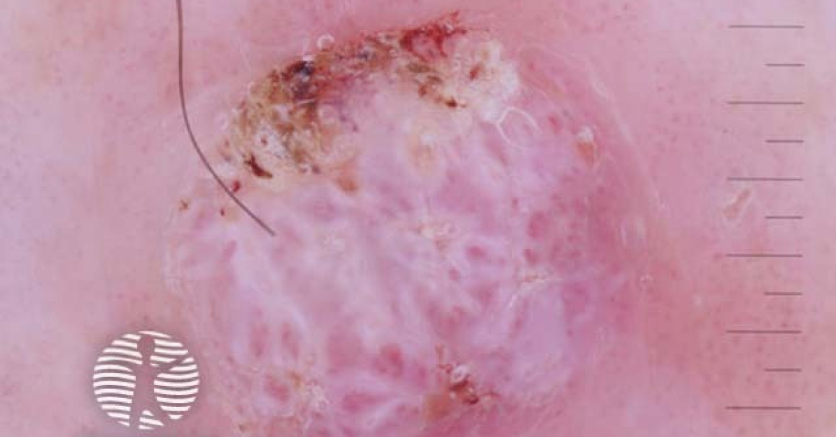 White structureless areas and surface keratin in squamous