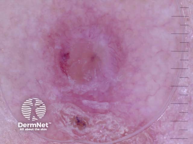 Squamous cell carcinoma nonpolarised dermoscopy view