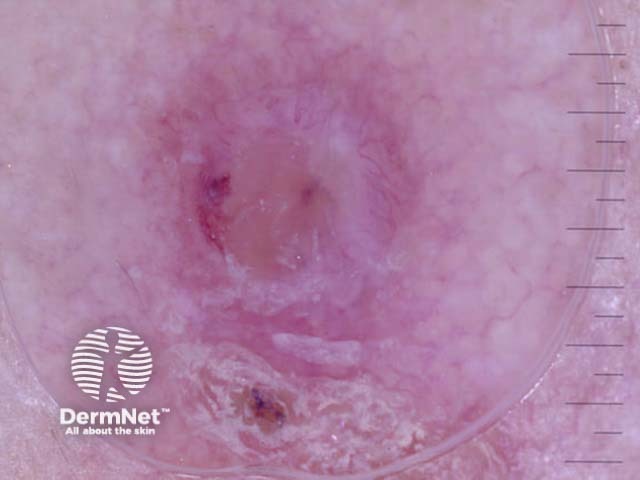 Squamous Cell Carcinoma Nonpolarised Dermoscopy View Image