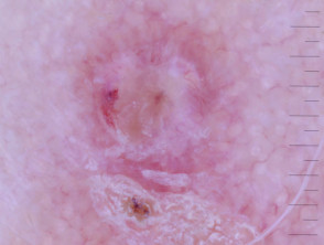 Loop vessels seen in squamous cell carcinoma dermoscopy