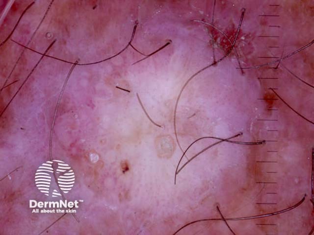 Squamous cell carcinoma, keratoacanthoma type, nonpolarised dermoscopy view