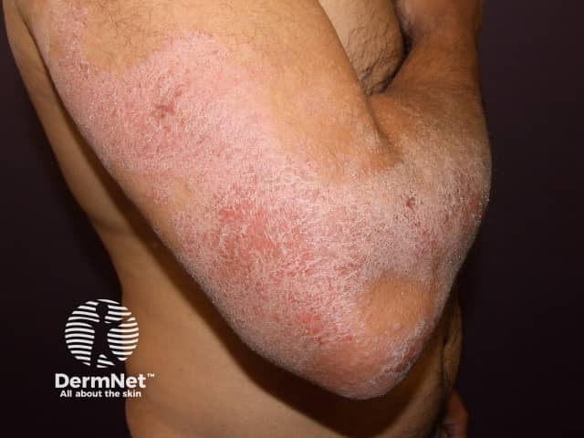 Dry atopic dermatitis in an extensor pattern