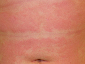 Subacute atopic dermatitis