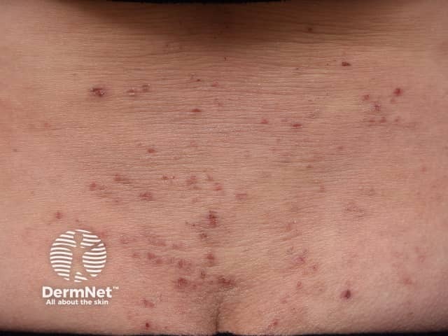 Excoriated lichenified atopic dermatitis on the lower back in an adult