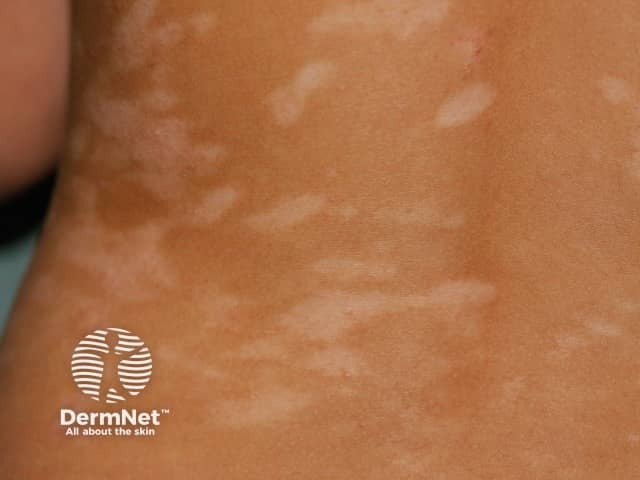 Postinflammatory hypopigmentation due to atopic dermatitis