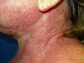 Atopic dermatitis affecting neck