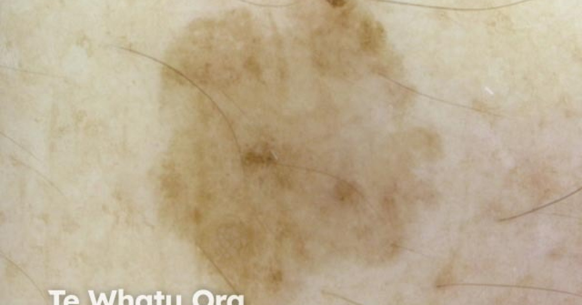 Solar lentigo dermoscopy image