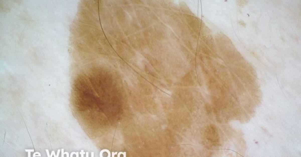 Solar lentigo dermoscopy image