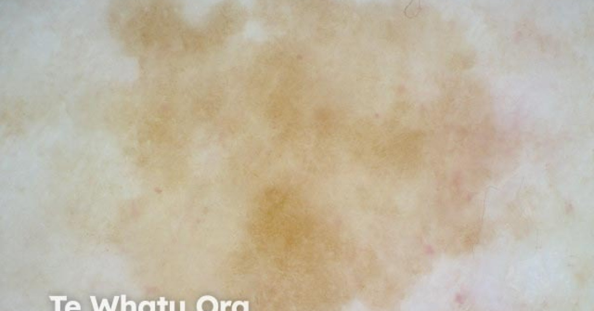 Solar lentigo dermoscopy image