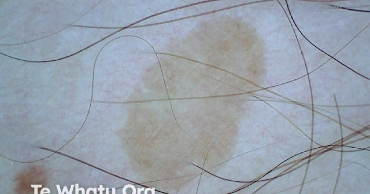 Solar lentigo dermoscopy image