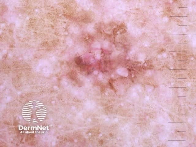 Superficial spreading melanoma dermoscopy