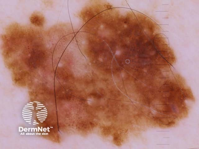 Superficial spreading melanoma, Breslow 0.3mm, polarised dermoscopy view