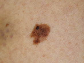 Superficial spreading melanoma in situ