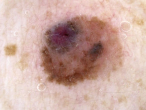 Superficial spreading melanoma dermoscopy