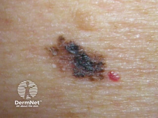 Macro image of superficial spreading melanoma 6