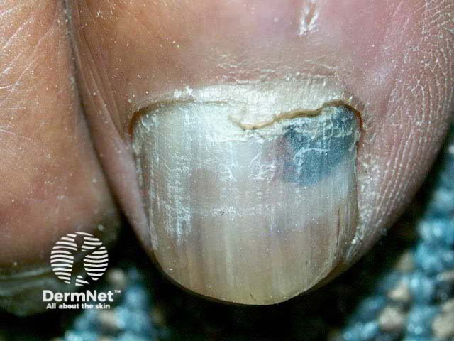 Subungual haematoma, toenail