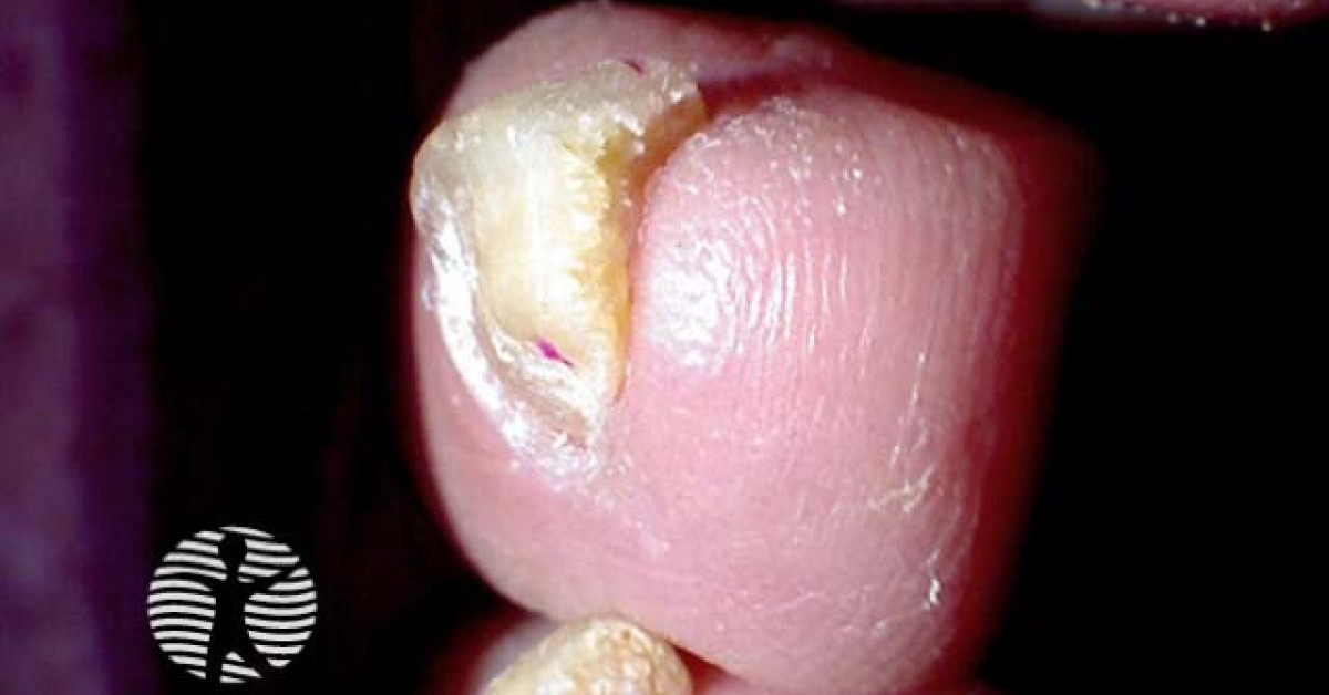 Subungual hyperkeratosis image