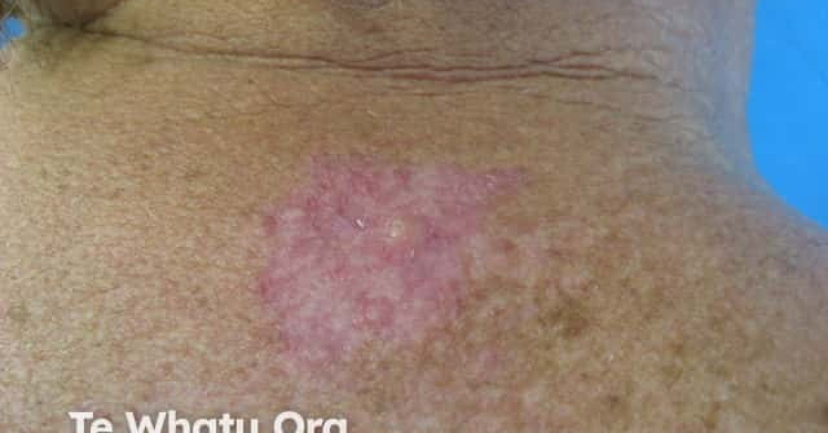 Superficial basal cell carcinoma, back image