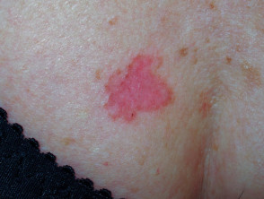 Superficial basal cell carcinoma, chest