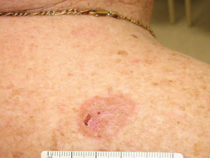 Superficial basal cell carcinoma, shoulder