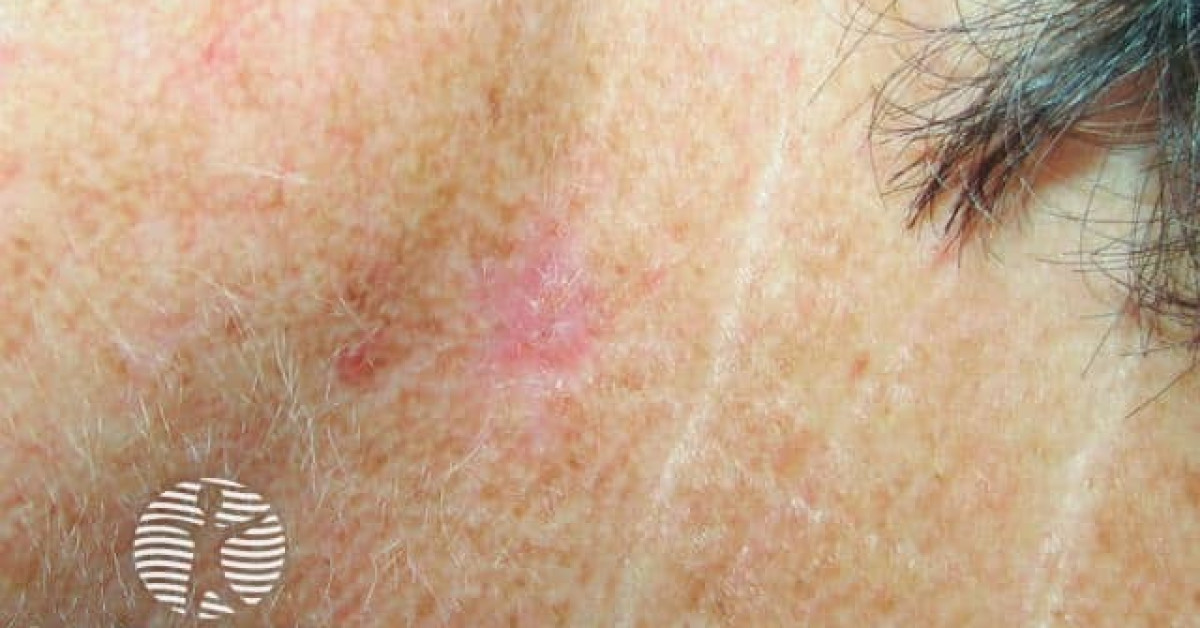 Superficial basal cell carcinoma, neck image