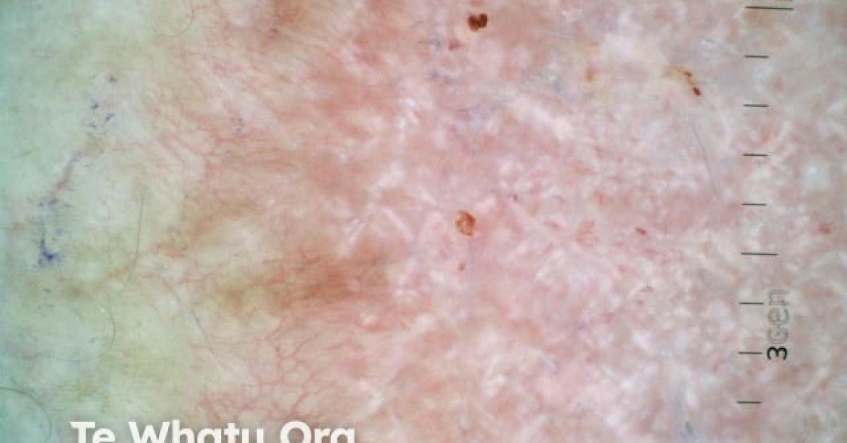 Superficial Basal Cell Carcinoma Dermoscopy Image