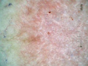 Superficial basal cell carcinoma dermoscopy