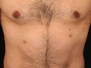 Supernumerary nipples