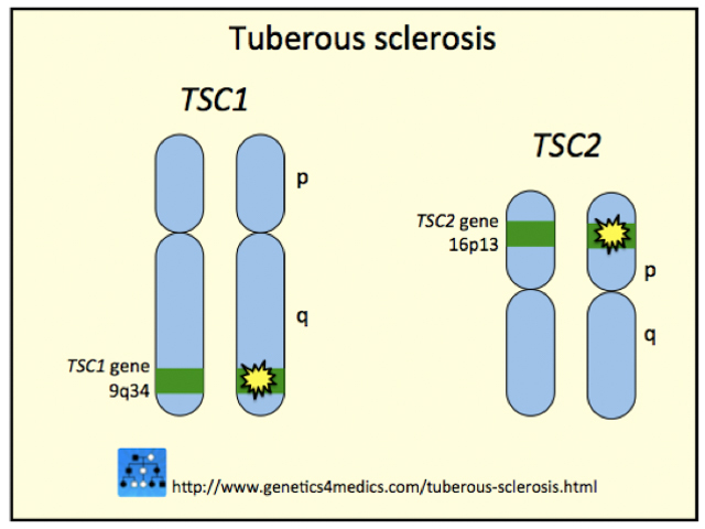 Genetics of Tuberous sclerosis*