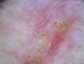 Acanthoma fissuratum — dermoscopy view