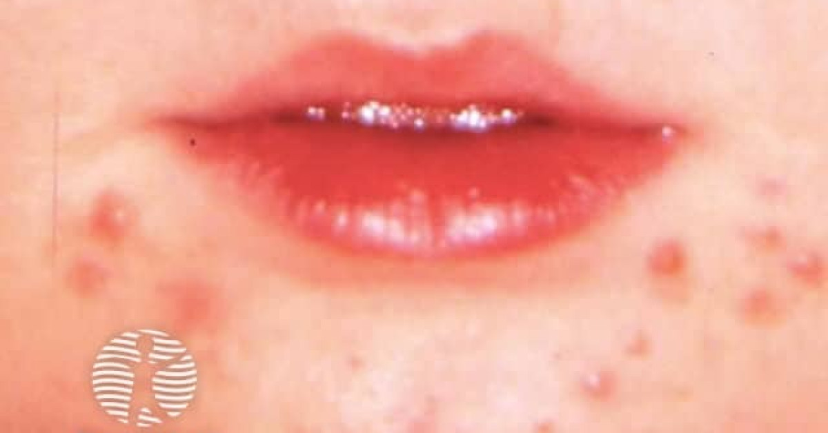 Perioral Acne Image