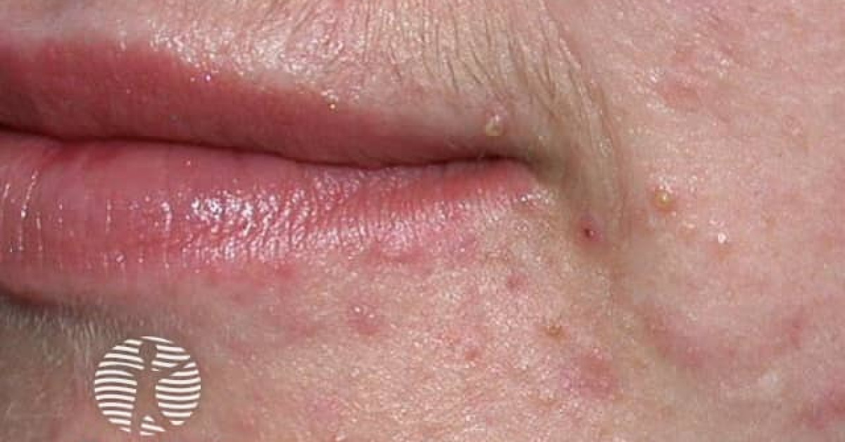 perioral-acne-image