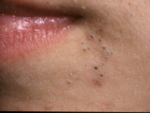 Perioral acne