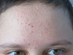 Acne due to systemic steroids