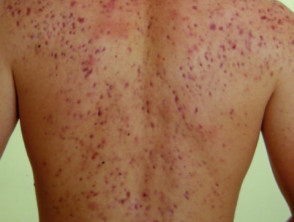 Nodulocystic acne